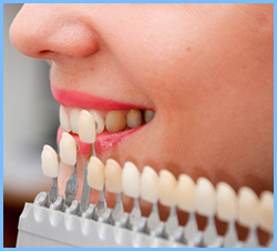 veneers