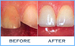 veneers